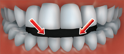 An open bite occurs when the back teeth are together and there is an opening<br /> between the lower and upper front teeth